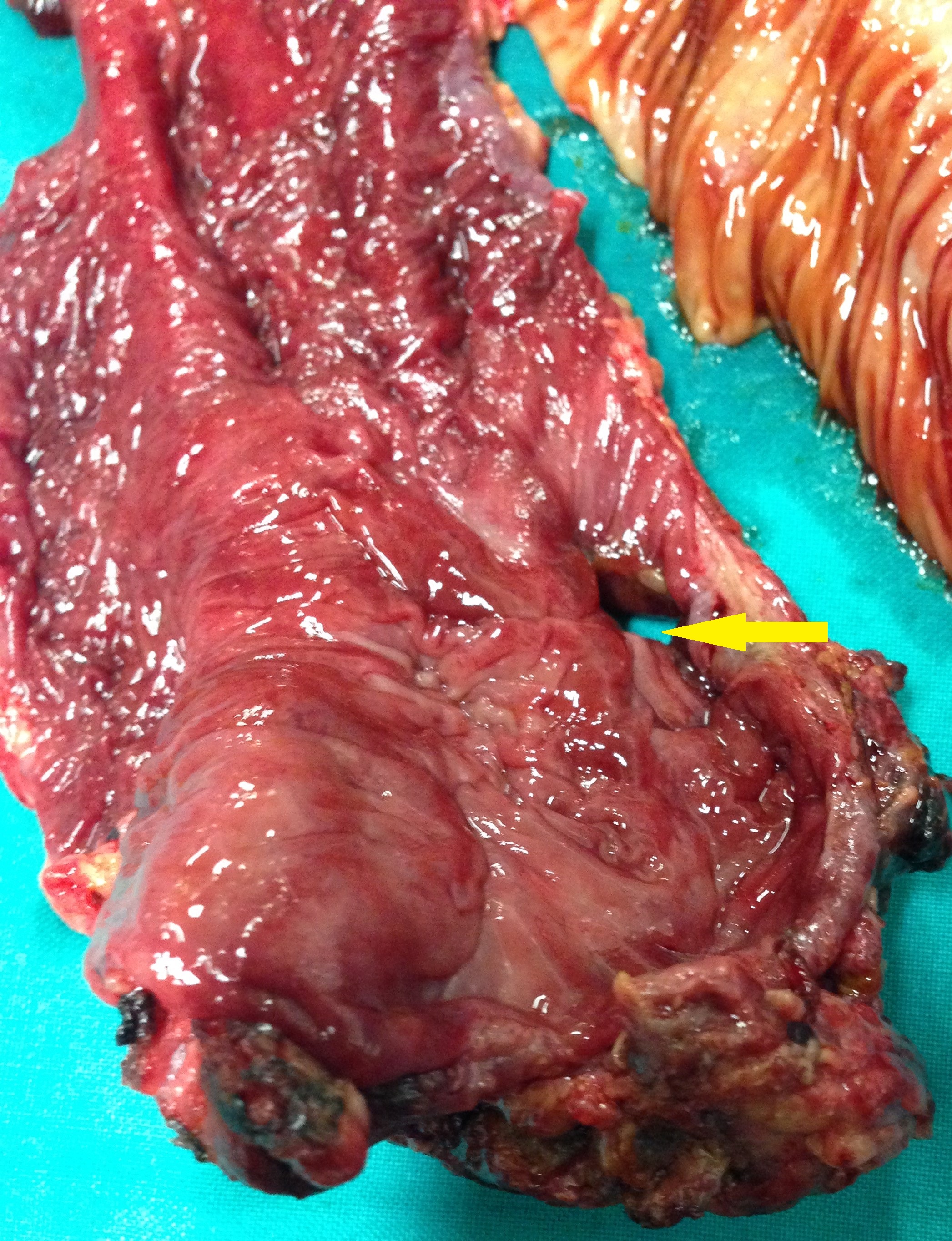 ULCERATIVE COLITIS - PERFORATION