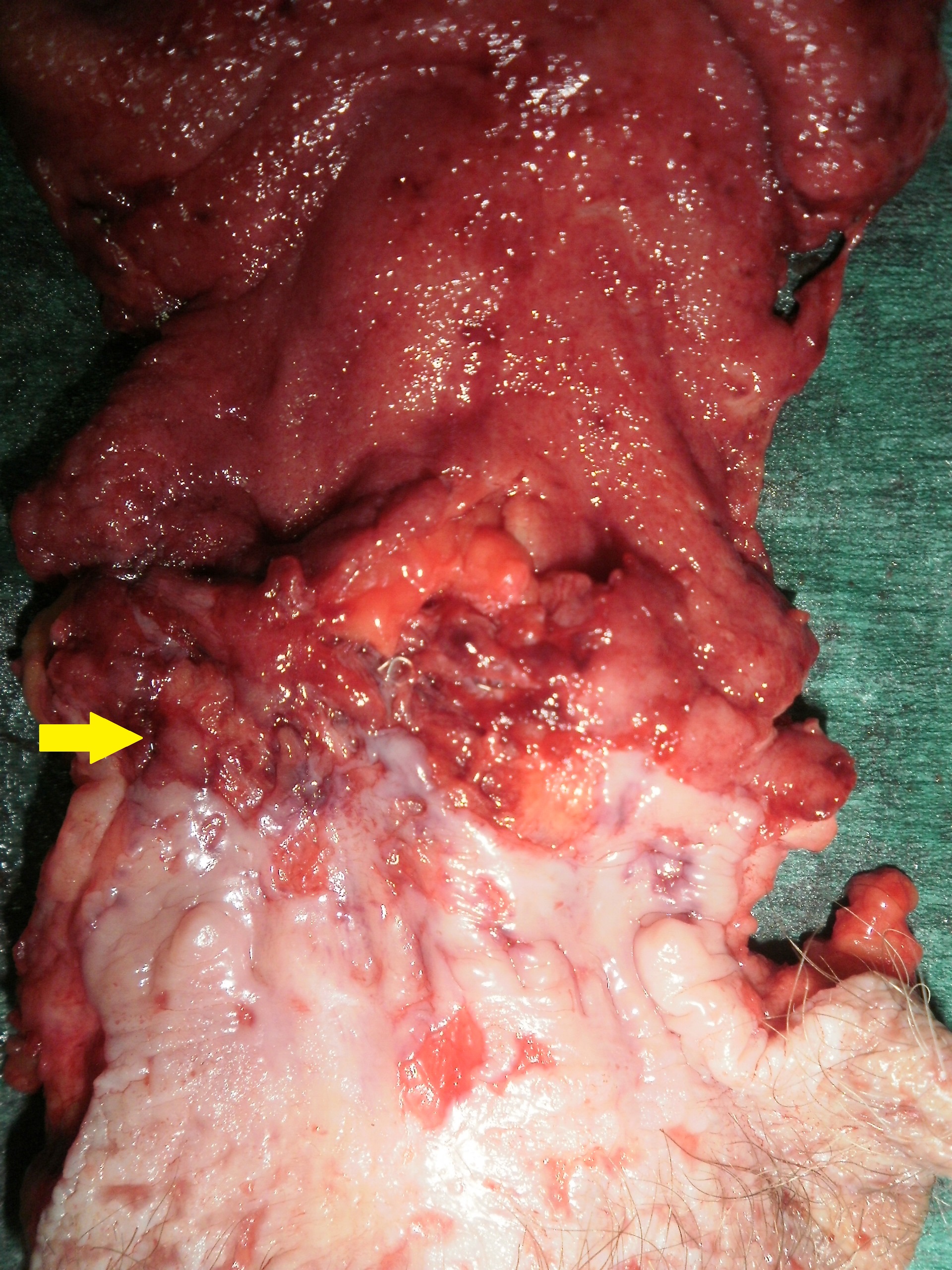 ILEAL POUCH ADENOCARCINOMA
