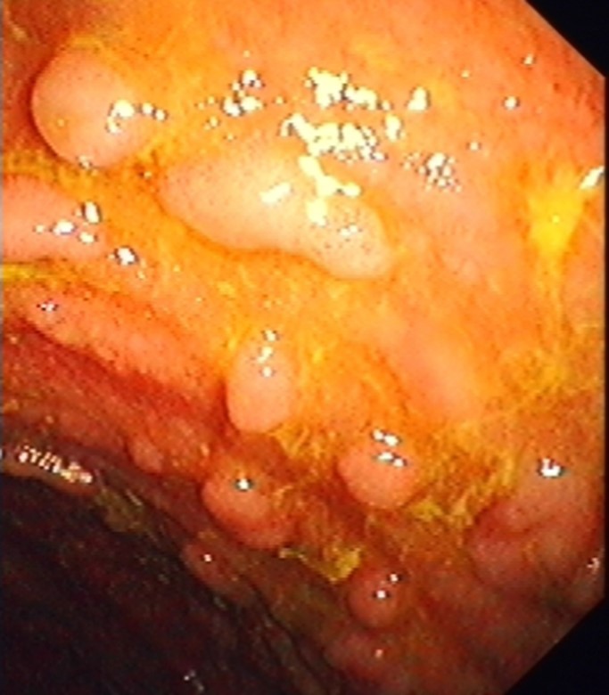 POUCH ADENOMAS