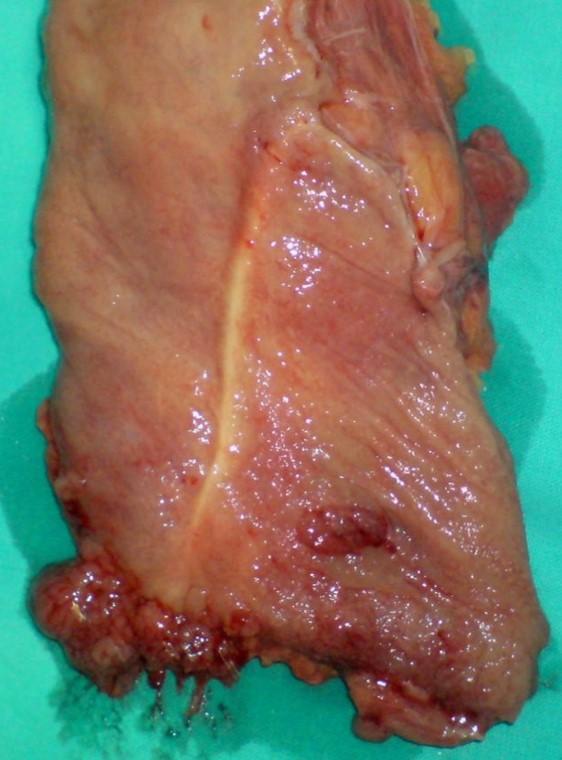 ILEAL POUCH ADENOCARCINOMA