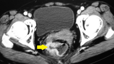 POUCH ADENOCARCINOMA
