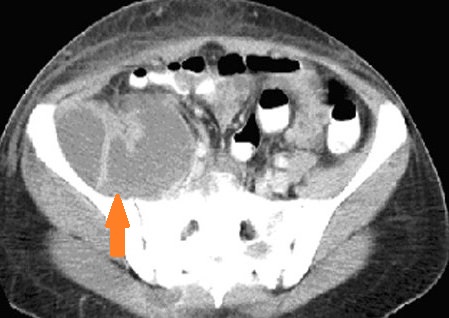 CROHN'S DISEASE - PSOAS ABSCESS