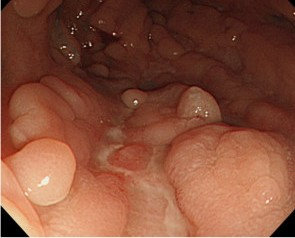 SYSTEMIC LUPUS ERYTHEMATOSUS - CROHN'S DISEASE