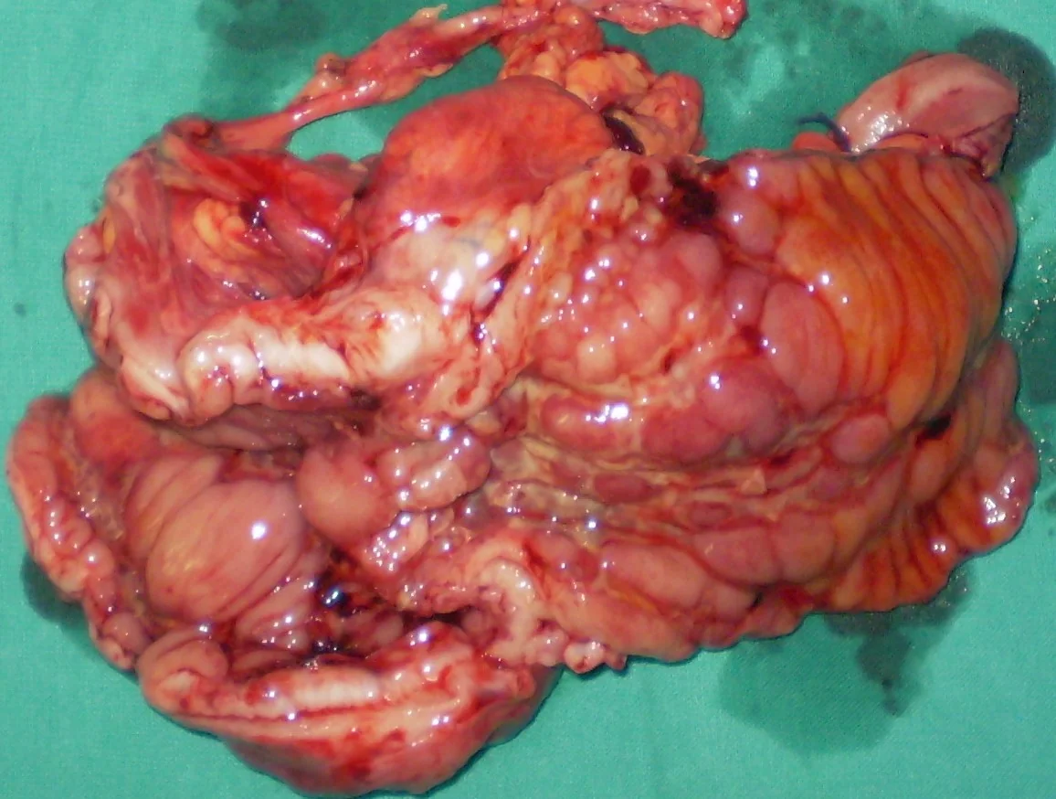 CROHN'S DISEASE - ILEAL OBSTRUCTION