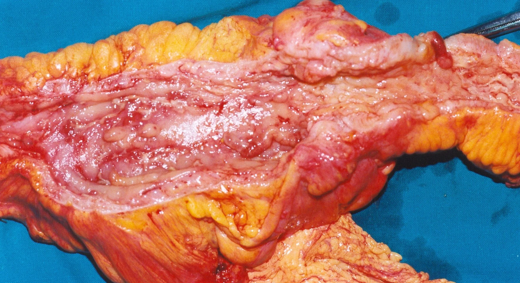 CROHN'S DISEASE