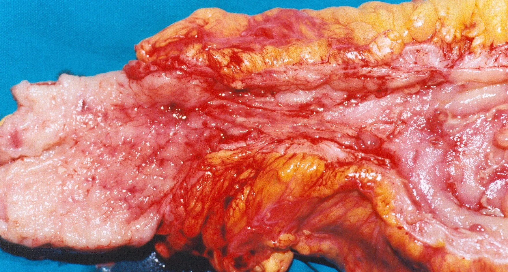 CROHN'S DISEASE