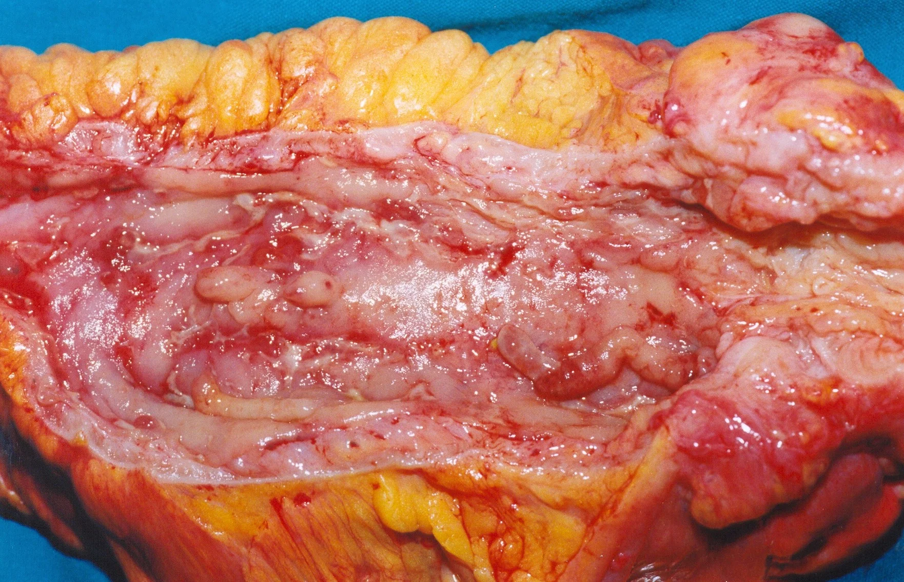 CROHN'S DISEASE