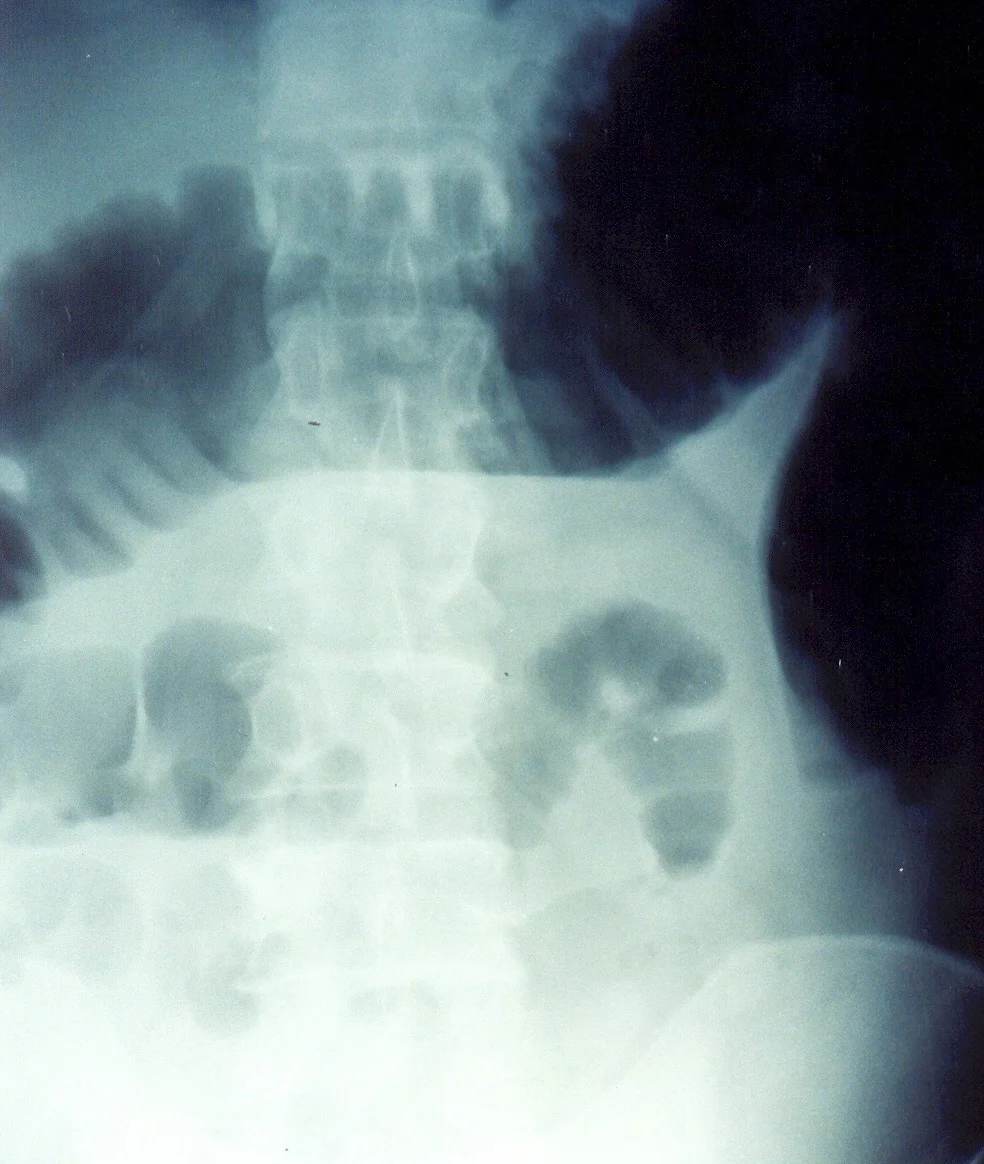TOXIC MEGACOLON