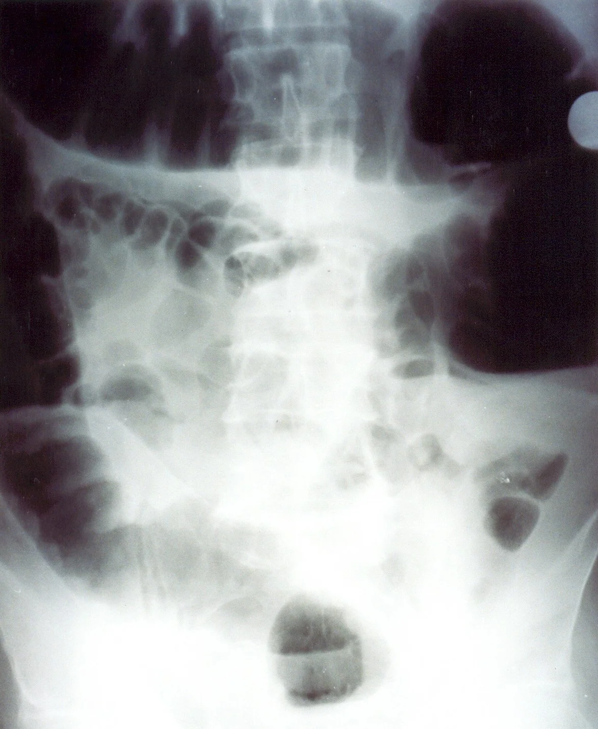 TOXIC MEGACOLON