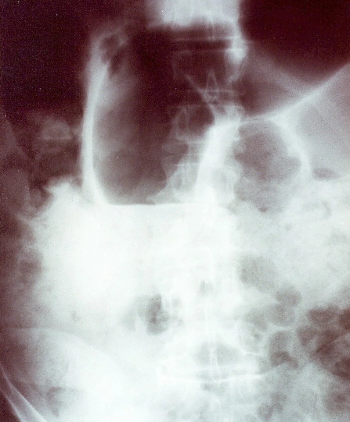 TOXIC MEGACOLON