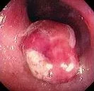 ULCERATIVE COLITIS - PSEUDOPOLYPS