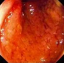 ULCERATIVE COLITIS