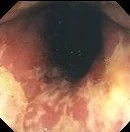 ULCERATIVE COLITIS