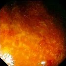 ULCERATIVE COLITIS