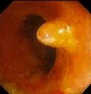 ULCERATIVE COLITIS - PSEUDOPOLYPS