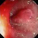 ULCERATIVE COLITIS - PSEUDOPOLYPS
