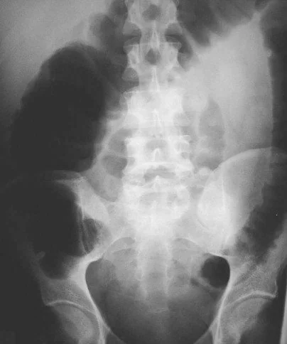 TOXIC MEGACOLON