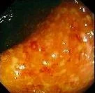 ULCERATIVE COLITIS - ULCERS