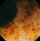 ULCERATIVE COLITIS - ULCERS