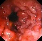 ULCERATIVE COLITIS - ULCERS