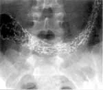 ULCERATIVE COLITIS