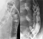 ULCERATIVE COLITIS