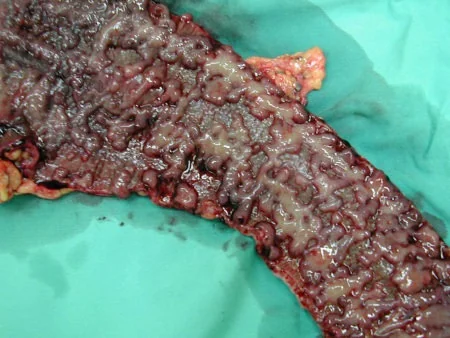ULCERATIVE COLITIS