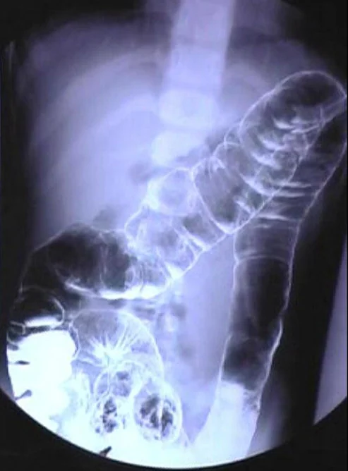 ULCERATIVE COLITIS