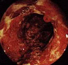 ULCERATIVE COLITIS - ULCERS