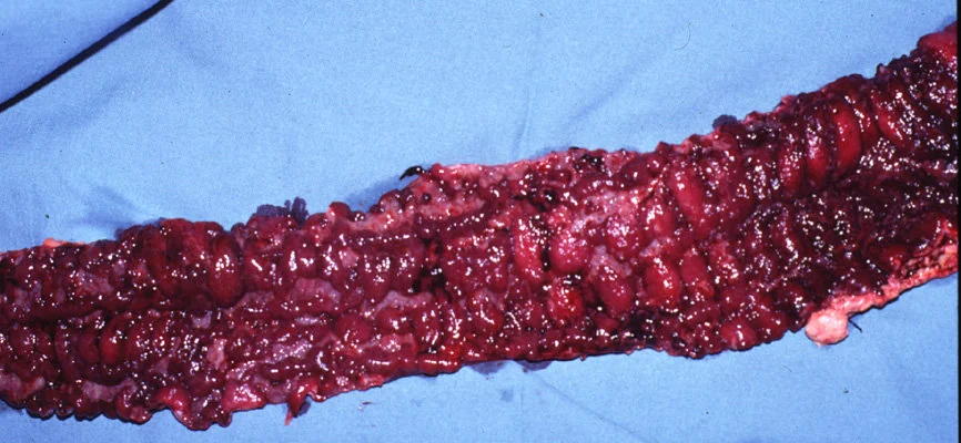 ULCERATIVE COLITIS