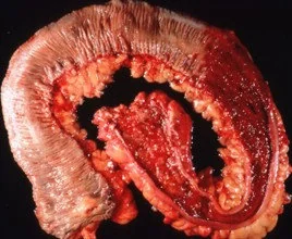 ULCERATIVE COLITIS