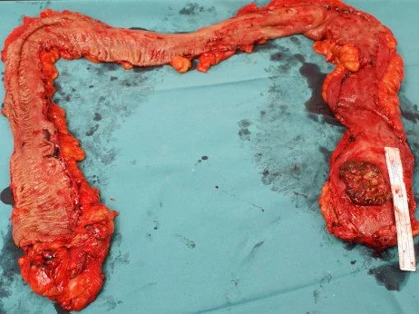 ULCERATIVE COLITIS + SMALL CELL CARCINOMA