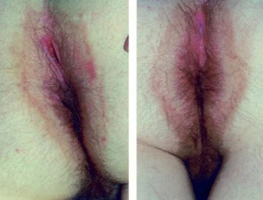 BEHCET DISEASE - ULCER NATAL CLEFT