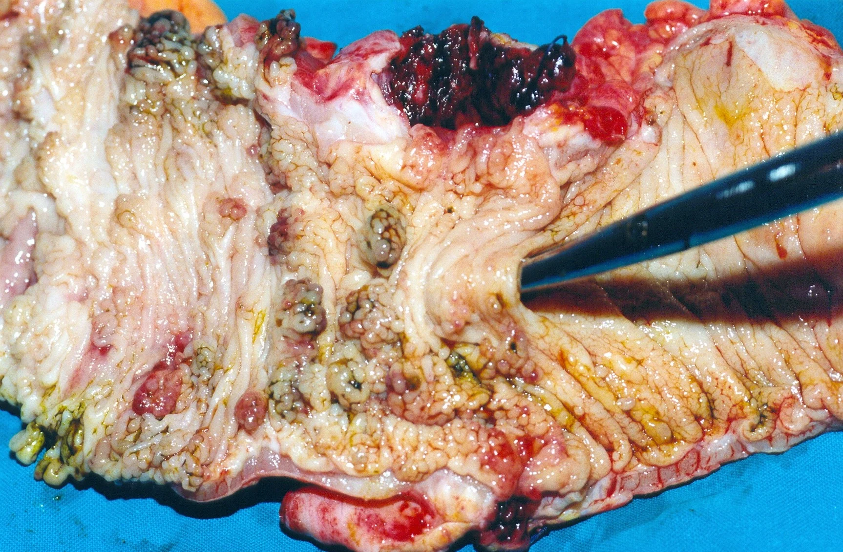 CROHN'S DISEASE - SIGMOID COLON
