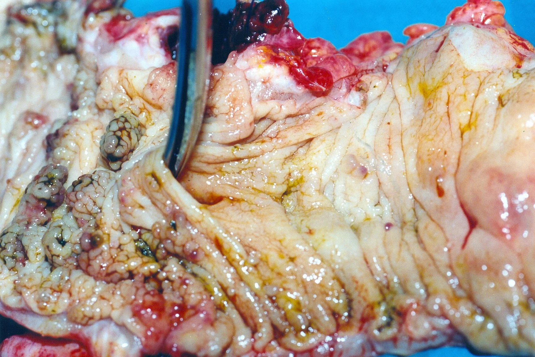 CROHN'S DISEASE - SIGMOID COLON