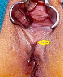 CROHN'S DISEASE - RECTOVAGINAL FISTULA