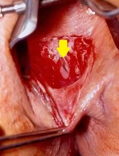 CROHN'S DISEASE - RECTOVAGINAL FISTULA