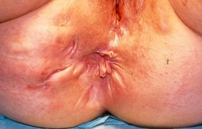 CROHN'S DISEASE - FISTULAE IN ANO