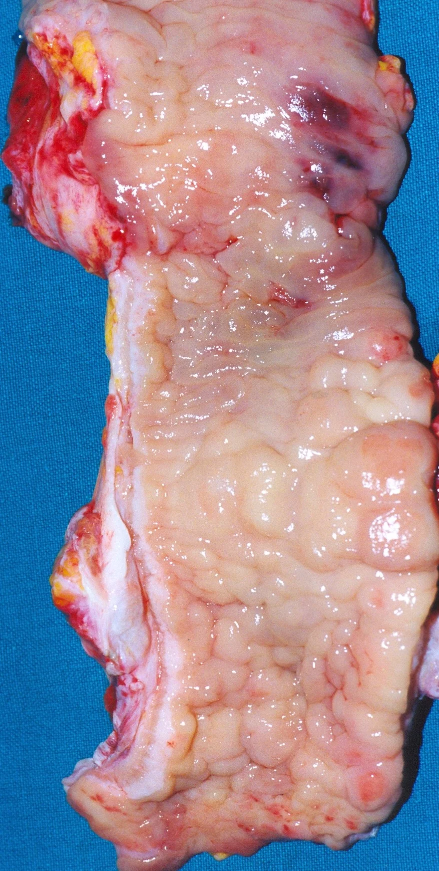 COLONIC CROHN'S DISEASE