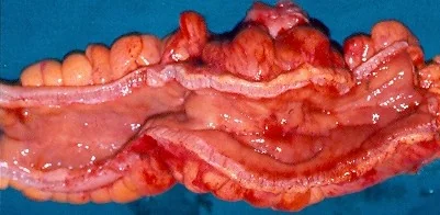 COLONIC CROHN'S DISEASE