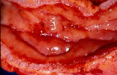 COLONIC CROHN'S DISEASE