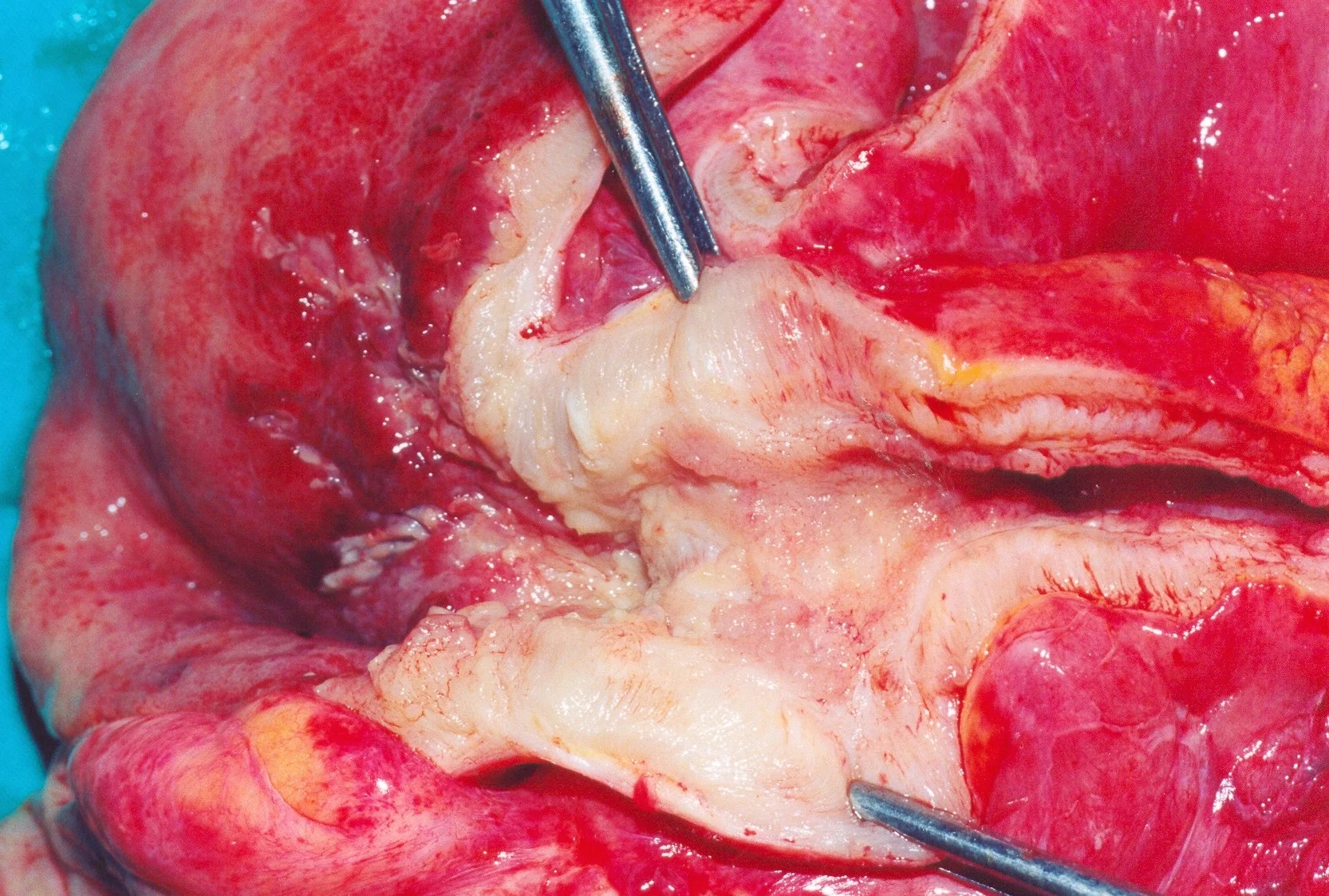 CROHN'S DISEASE - TERMINAL ILEITIS
