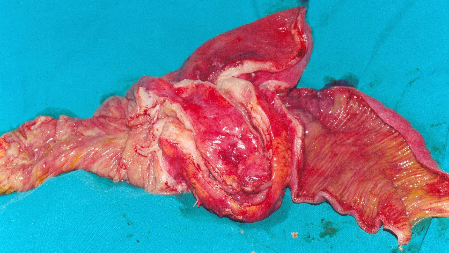 CROHN'S DISEASE - TERMINAL ILEITIS