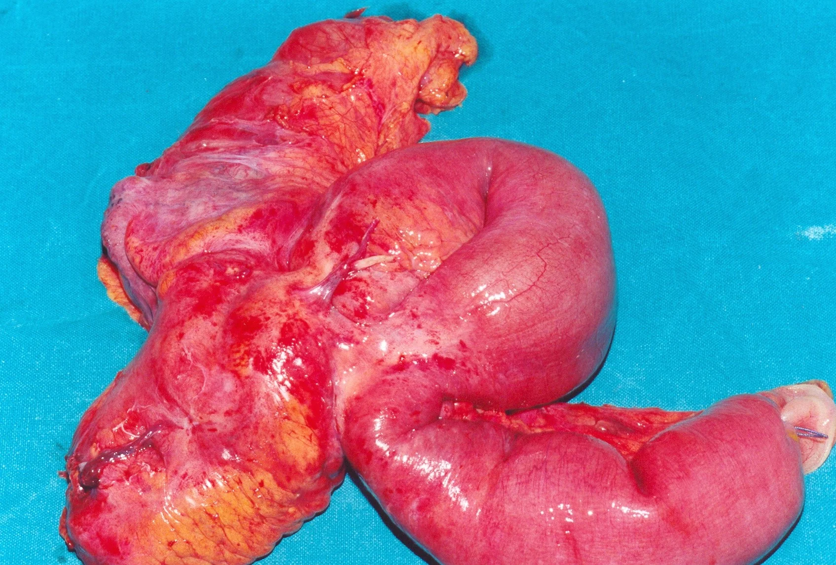 CROHN'S DISEASE 