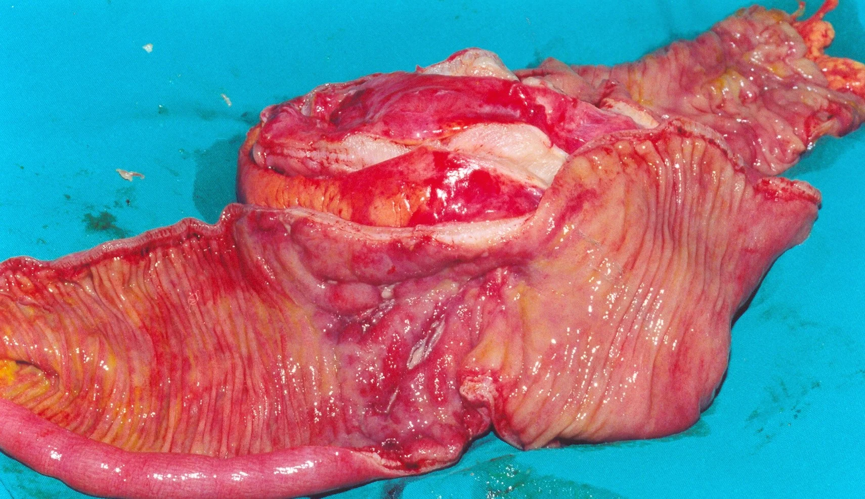 CROHN'S DISEASE