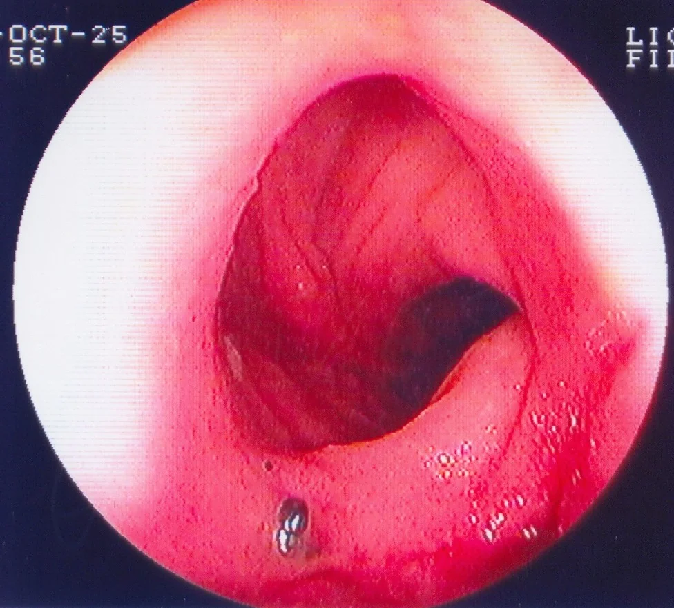 HEALTHY ILEAL POUCH