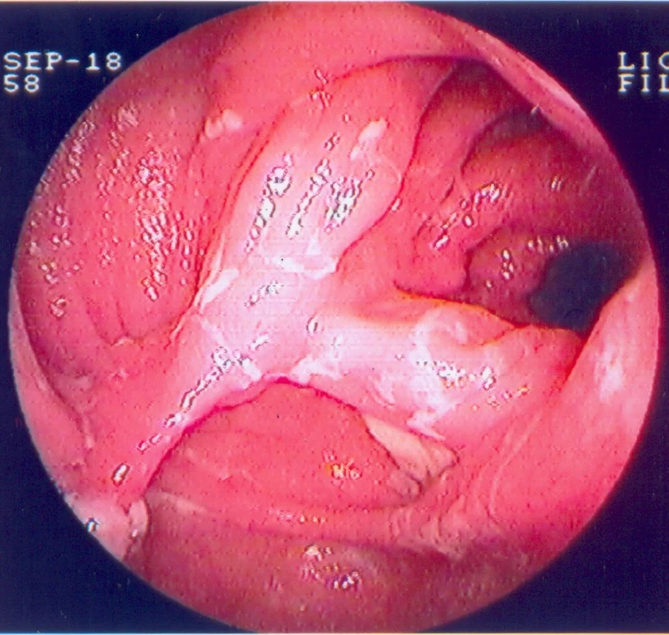 HEALTHY ILEAL POUCH