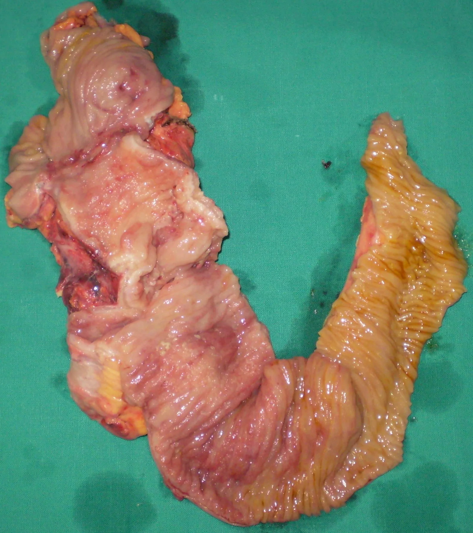 RECCURENT CROHN'S DISEASE