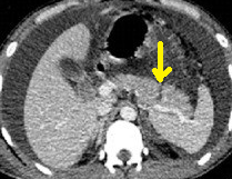 PANCREATIC TRAUMA