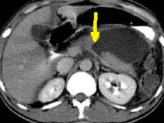 PANCREATIC TRAUMA